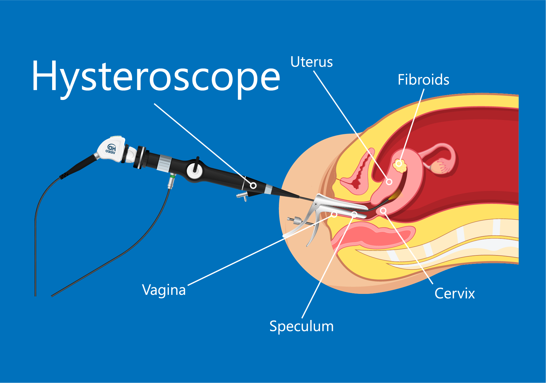 hysteroscope